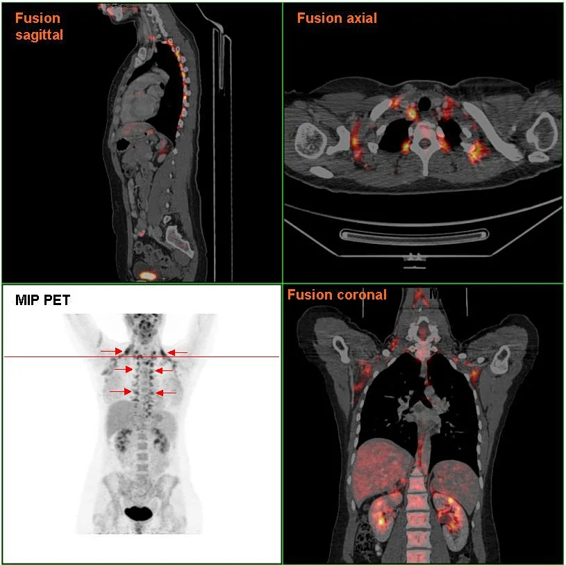 Graisse brune (en rouge) sur une image de tomographie PET